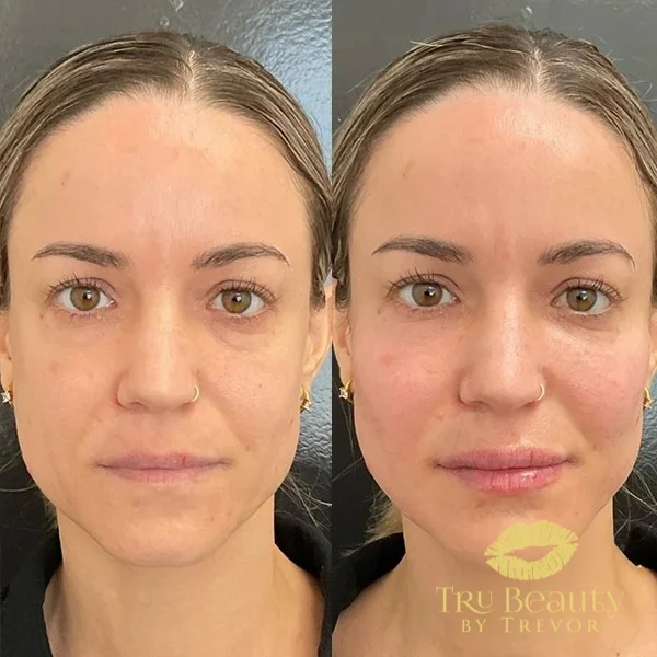 twenty-three-before-after