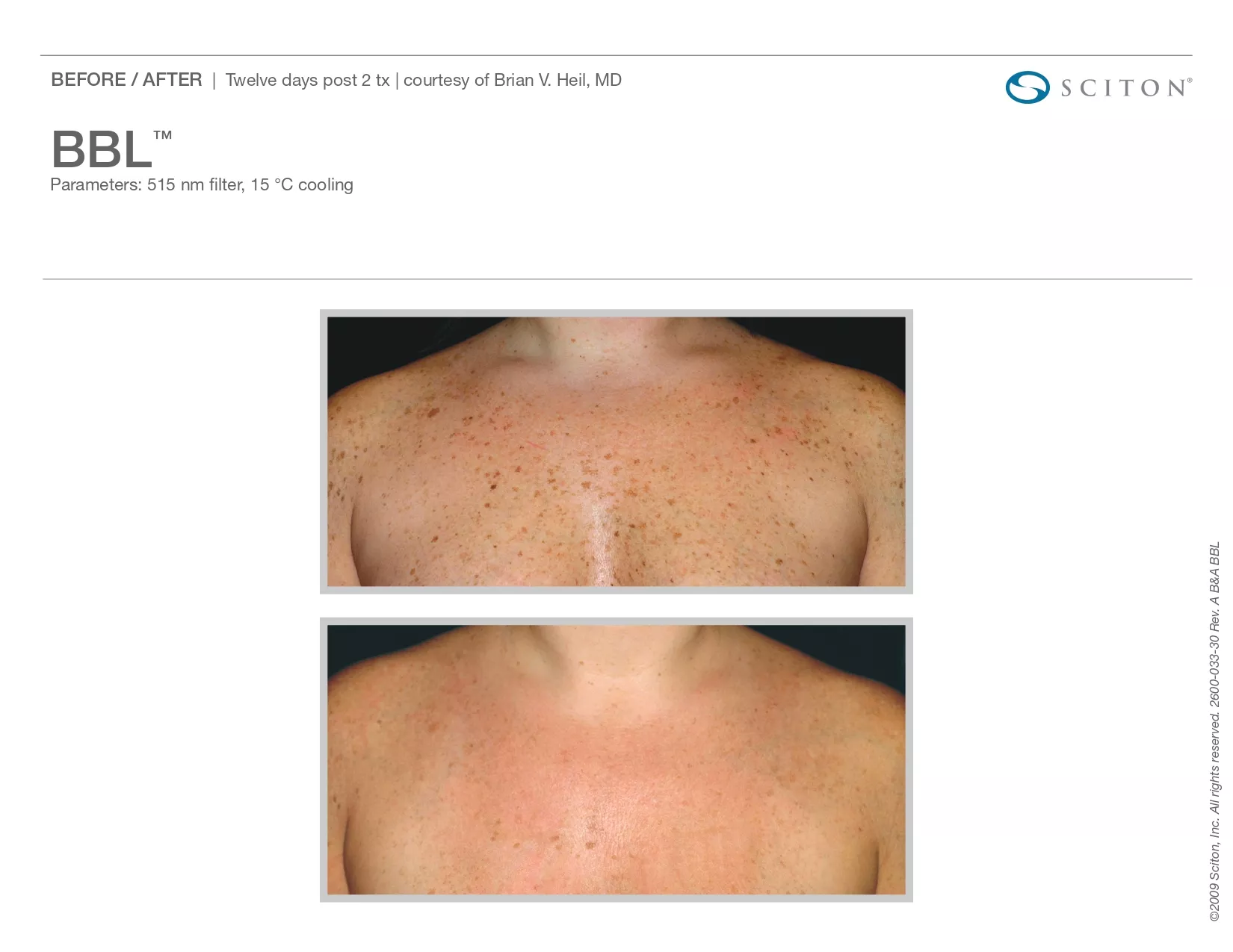 Trubeautybytrevor_Gallery_Image_BBL_Before_and_After_FIve_IN_HENDERSON_NV