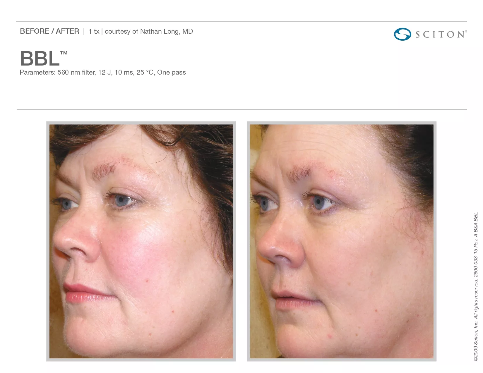 Trubeautybytrevor_Gallery_Image_BBL_Before_and_After_Four_IN_HENDERSON_NV