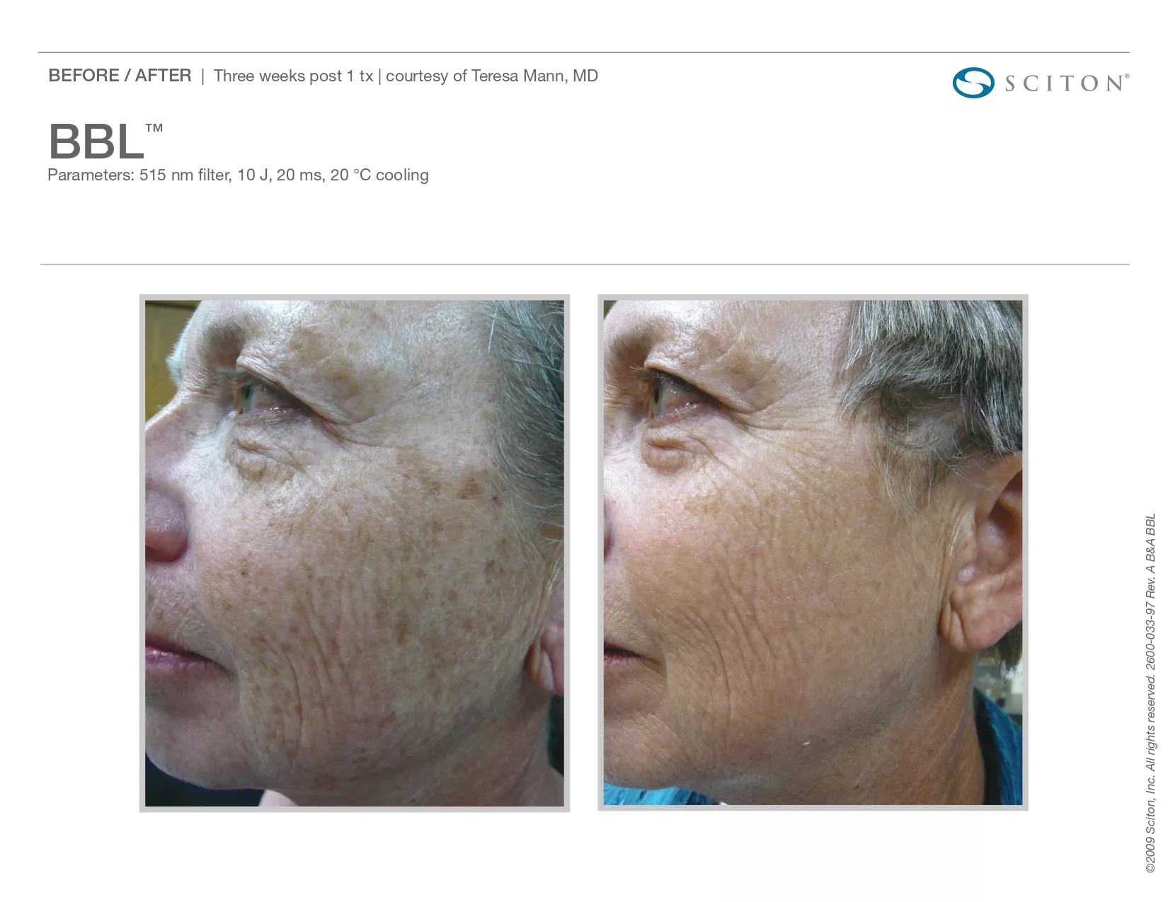 Trubeautybytrevor_Gallery_Image_BBL_Before_and_After_One_IN_HENDERSON_NV