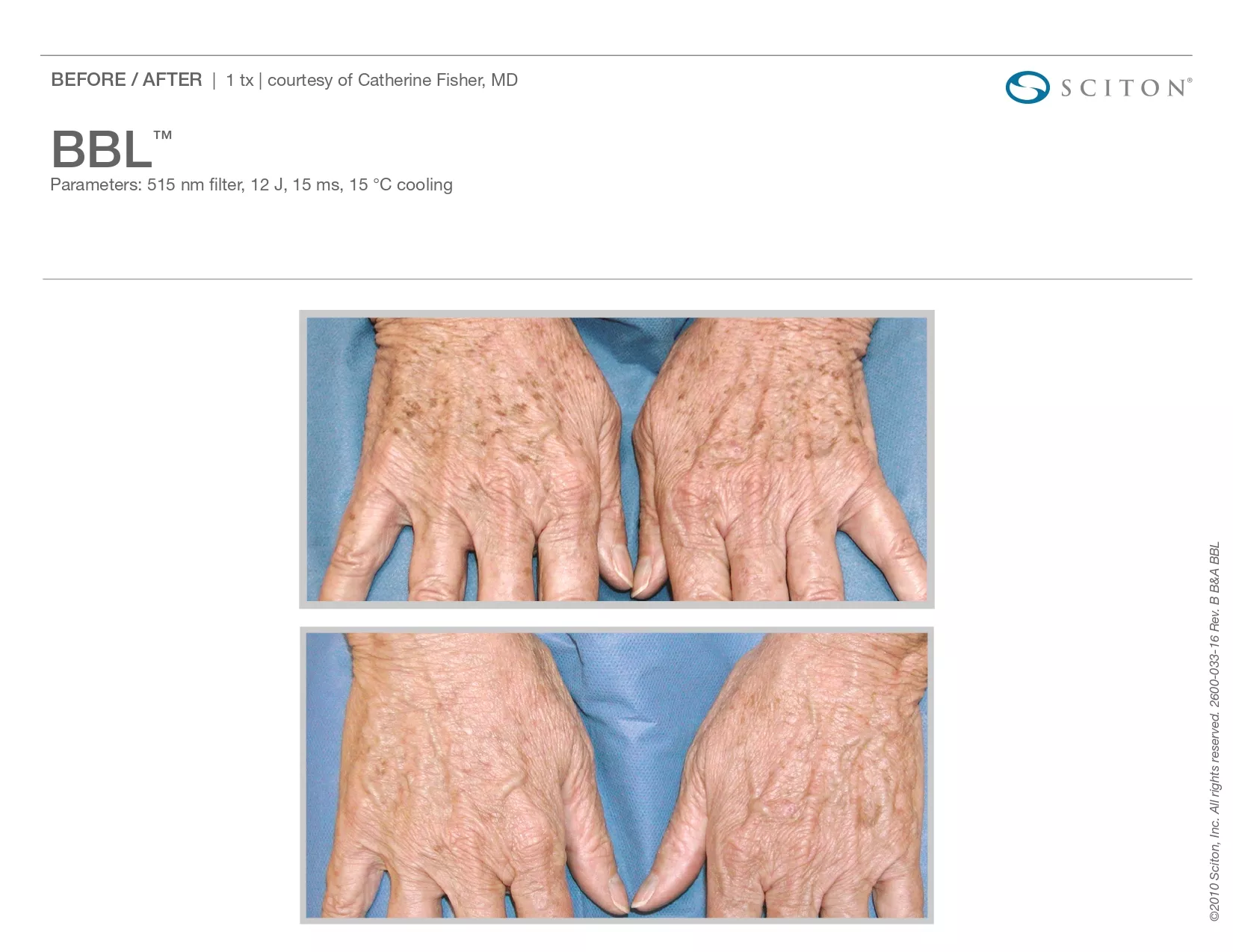 Trubeautybytrevor_Gallery_Image_BBL_Before_and_After_Three_IN_HENDERSON_NV