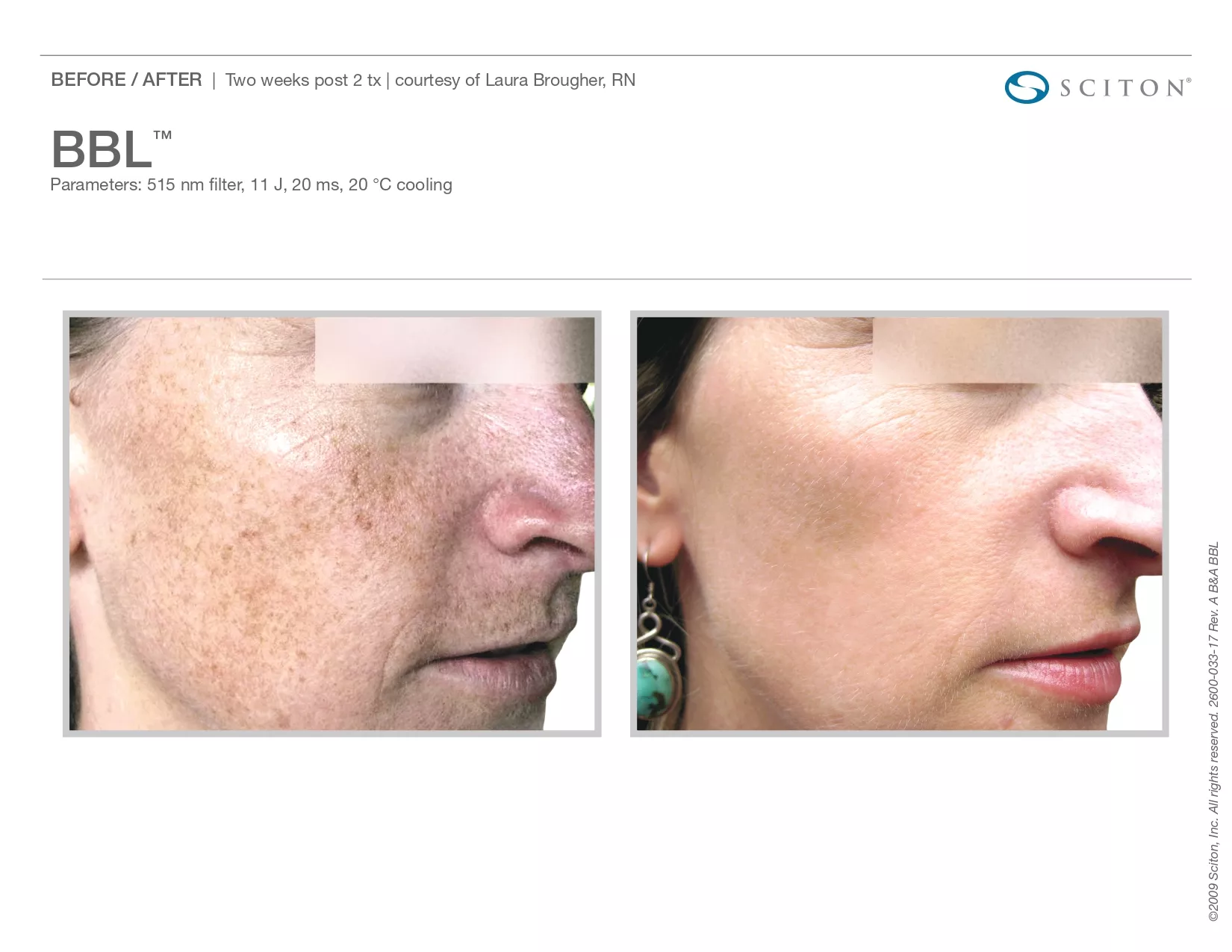 Trubeautybytrevor_Gallery_Image_BBL_Before_and_After_Two_IN_HENDERSON_NV