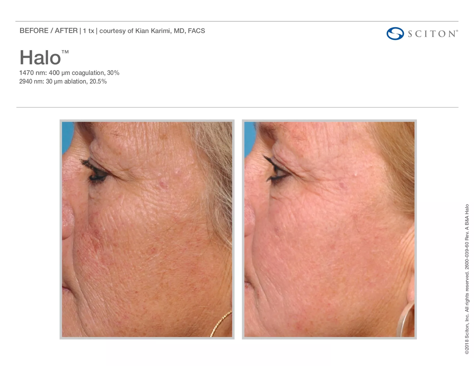 Trubeautybytrevor_Gallery_Image_Halo_Before_and_After_Six_IN_HENDERSON_NV