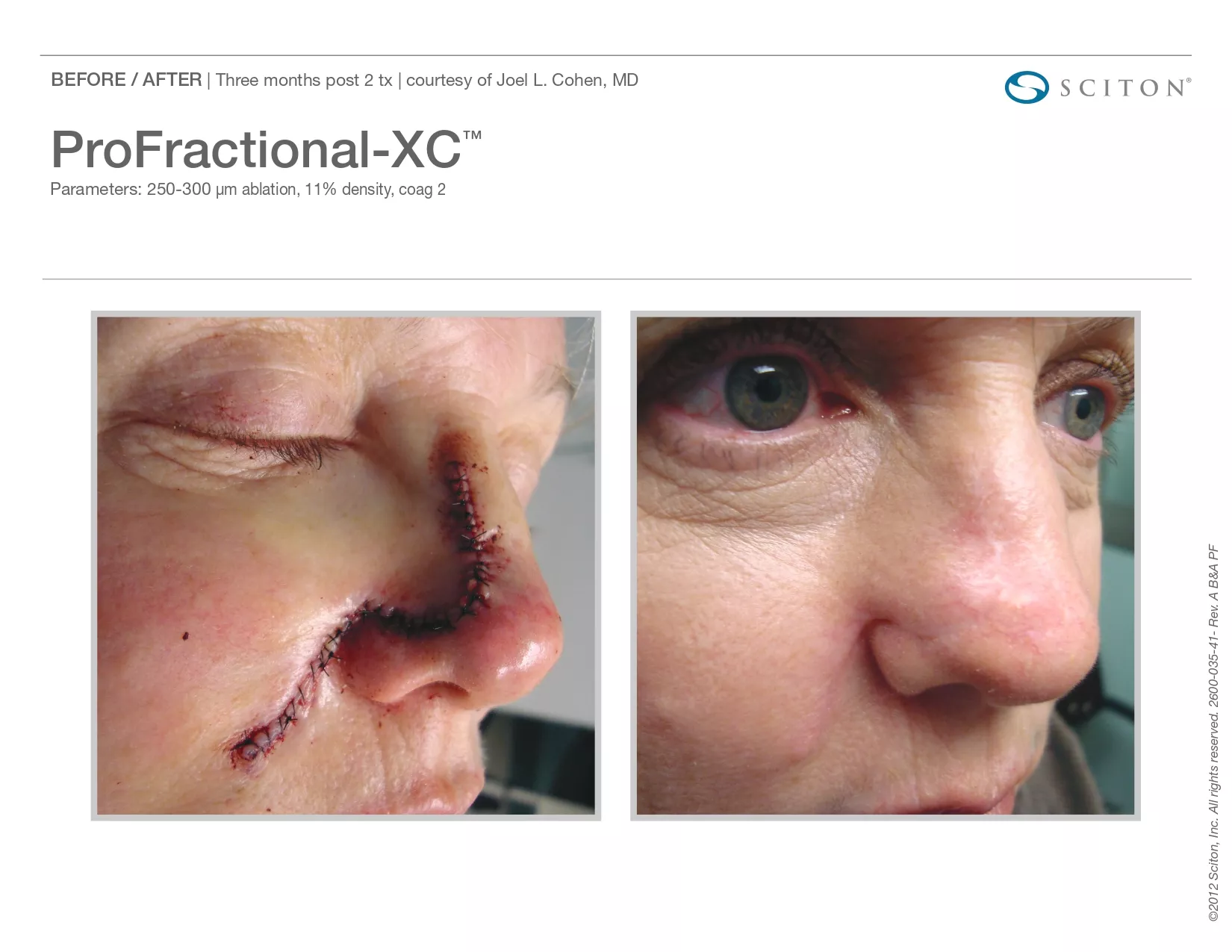 Trubeautybytrevor_Gallery_Image_PROFRACTIONAL_Before_and_After_Four_IN_HENDERSON_NV