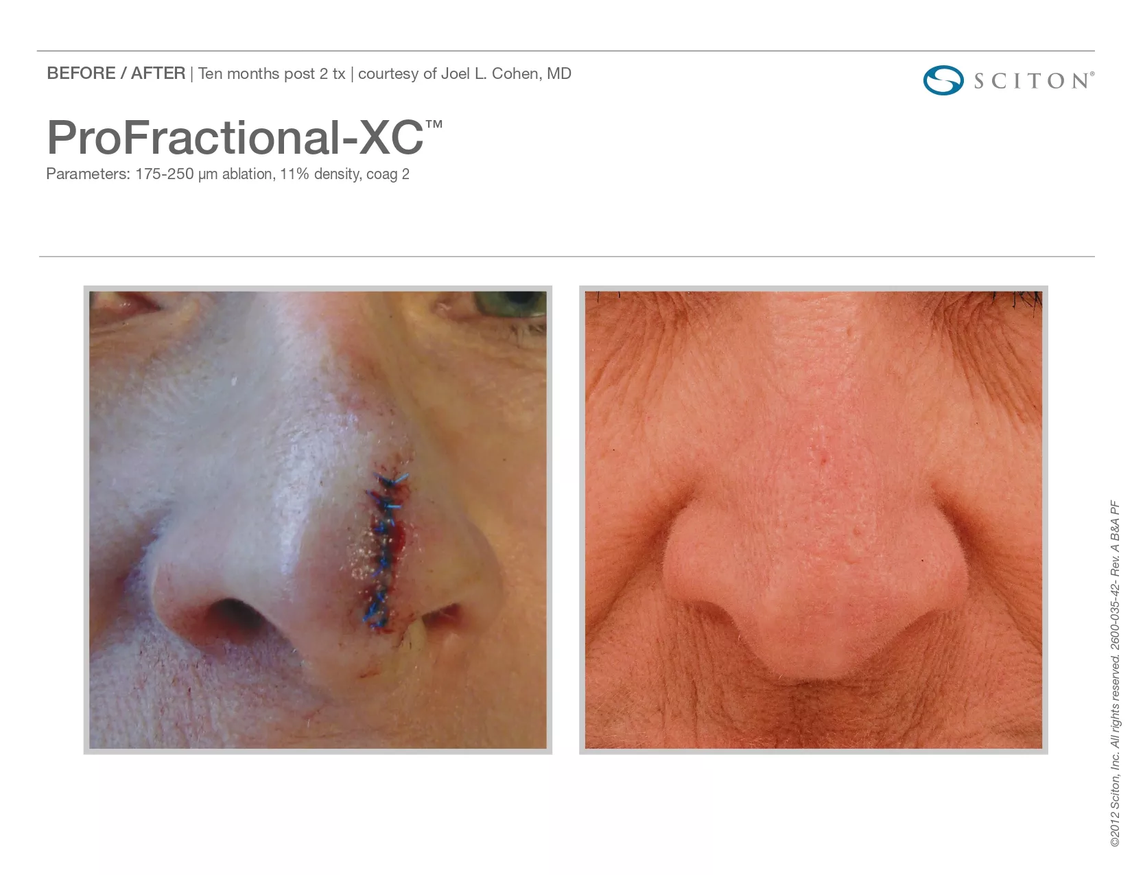 Trubeautybytrevor_Gallery_Image_PROFRACTIONAL_Before_and_After_Four_IN_HENDERSON_NV