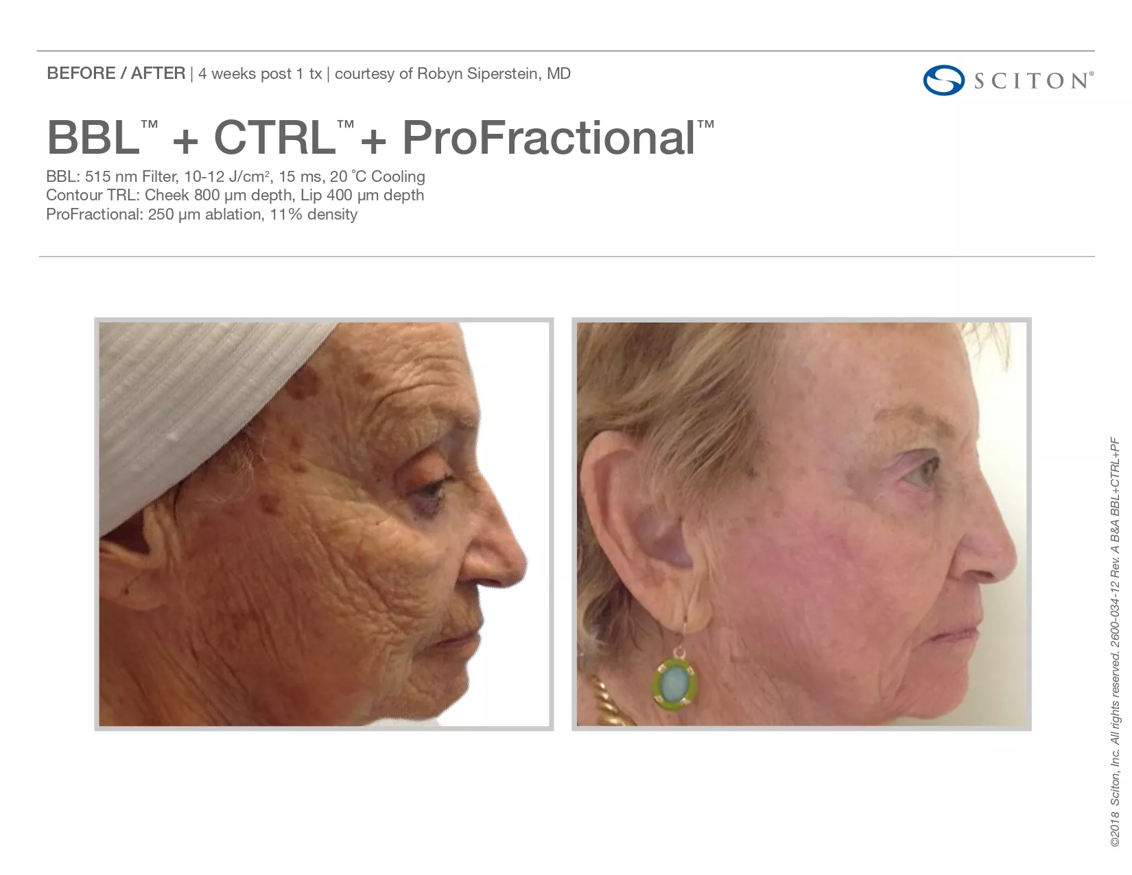 Trubeautybytrevor_Gallery_Image_PROFRACTIONAL_Before_and_After_Seven_IN_HENDERSON_NV