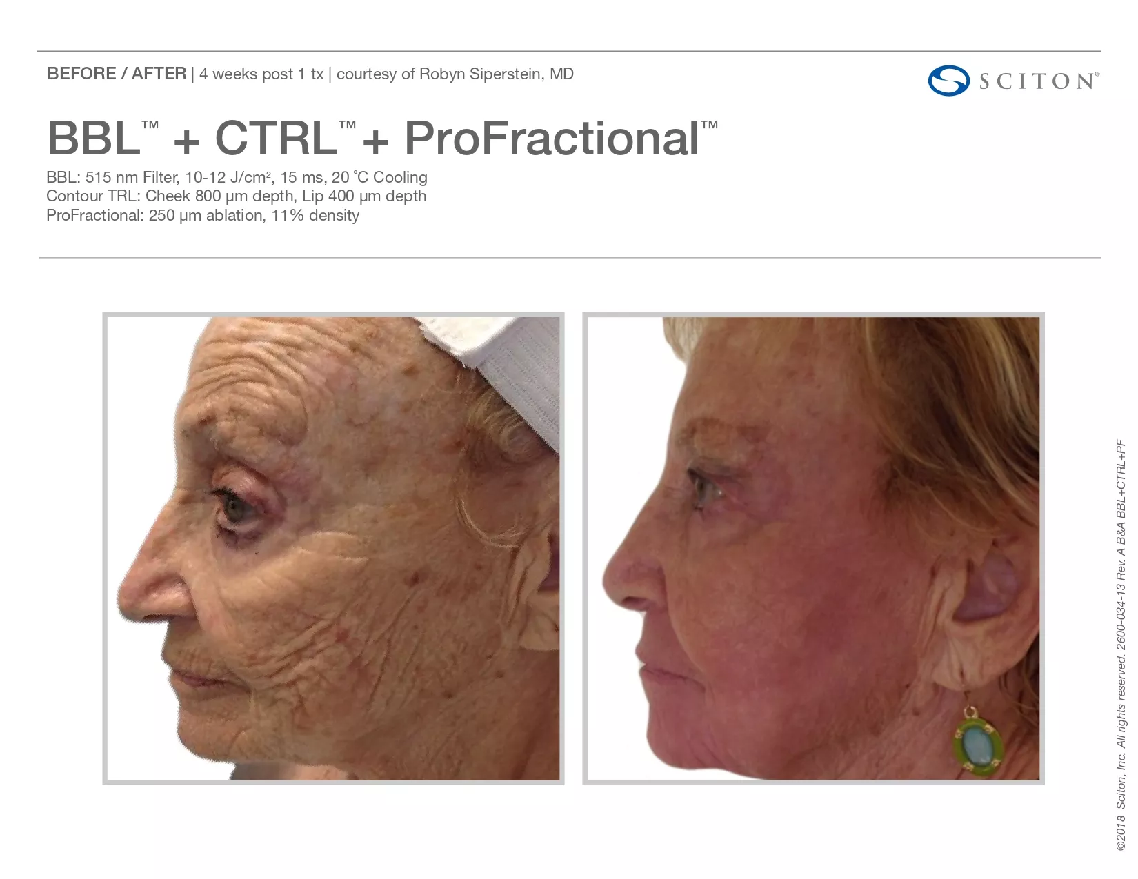Trubeautybytrevor_Gallery_Image_PROFRACTIONAL_Before_and_After_Four_IN_HENDERSON_NV